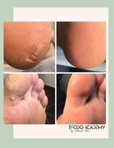 CURS BAZELE PEDICHIURII COMPLEXE – Nivel II