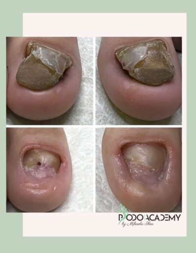 CURS BAZELE PEDICHIURII COMPLEXE – Nivel II