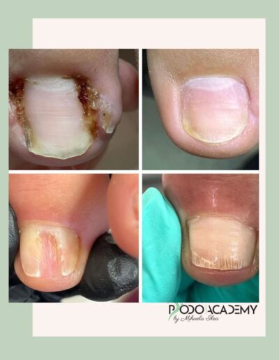 CURS BAZELE PEDICHIURII COMPLEXE – Nivel II