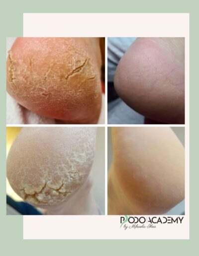 CURS BAZELE PEDICHIURII COMPLEXE – Nivel II