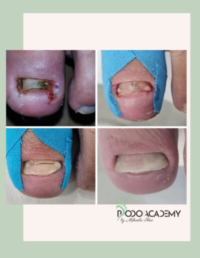 Curs TEHNICI COMBINATE DE CORECTARE A UNGHIILOR ÎNCARNATE – Nivel II