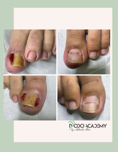 Curs TEHNICI COMBINATE DE CORECTARE A UNGHIILOR ÎNCARNATE – Nivel II