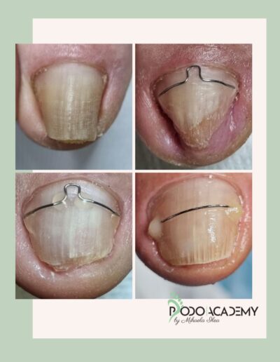 Curs TEHNICI COMBINATE DE CORECTARE A UNGHIILOR ÎNCARNATE – Nivel II