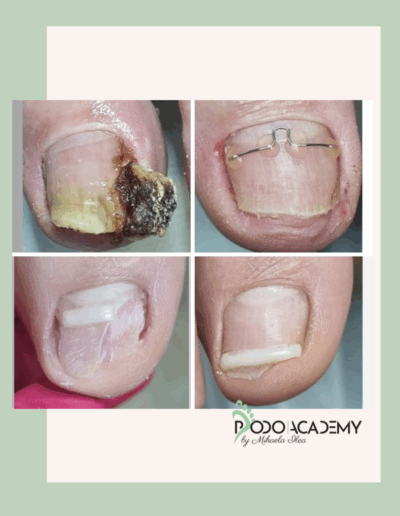 Curs TEHNICI COMBINATE DE CORECTARE A UNGHIILOR ÎNCARNATE – Nivel II