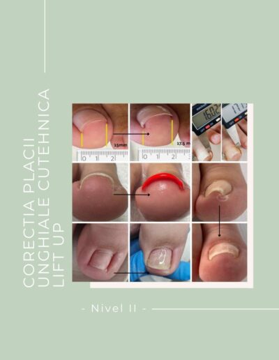 Curs CORECTAREA PLACII UNGHIALE CU TEHNICA LIFT UP – Nivel II