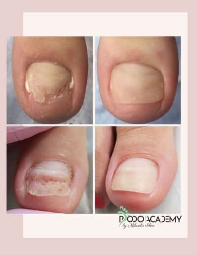 Curs ONICOLIZA SI PROTEZAREA IN PEDICHIURA ESTETICA – Nivel II