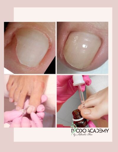 Curs ONICOLIZA SI PROTEZAREA IN PEDICHIURA ESTETICA – Nivel II