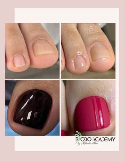 Curs ONICOLIZA SI PROTEZAREA IN PEDICHIURA ESTETICA – Nivel II