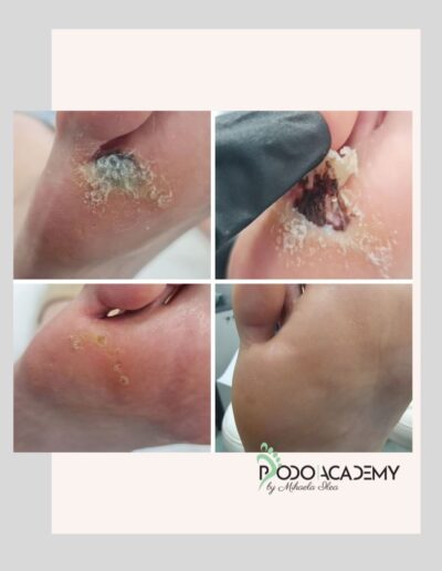 CURS ONLINE INDEPARTARE NEGI/VERUCI CU TERAPIA VERRU COMPLEX Podopharm – Nivel III