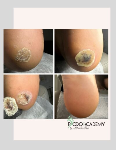CURS ONLINE INDEPARTARE NEGI/VERUCI CU TERAPIA VERRU COMPLEX Podopharm – Nivel III