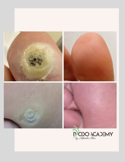 CURS ONLINE INDEPARTARE NEGI/VERUCI CU TERAPIA VERRU COMPLEX Podopharm – Nivel III