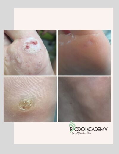 CURS ONLINE INDEPARTARE NEGI/VERUCI CU TERAPIA VERRU COMPLEX Podopharm – Nivel III