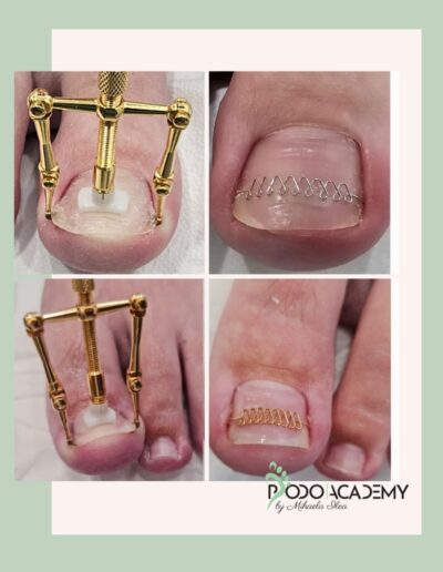 CURS CORECTAREA UNGHIEI INCARNATE CU TEHNICA SHIKAHAMA METHOD – Nivel III