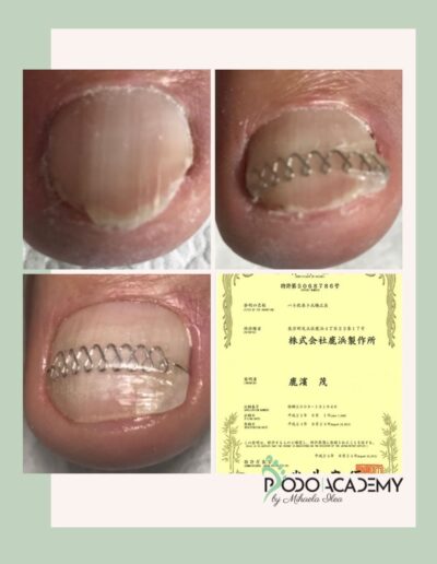 CURS CORECTAREA UNGHIEI INCARNATE CU TEHNICA SHIKAHAMA METHOD – Nivel III