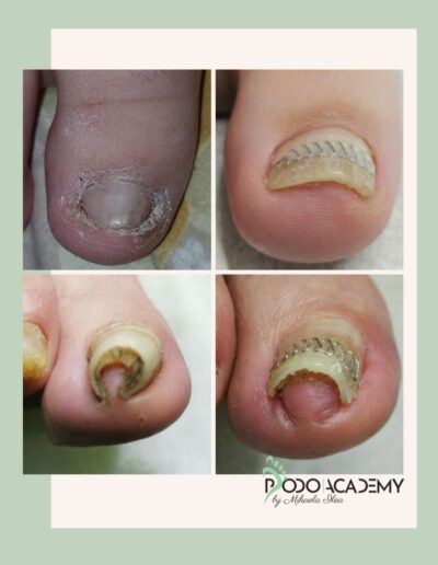 CURS CORECTAREA UNGHIEI INCARNATE CU TEHNICA SHIKAHAMA METHOD – Nivel III