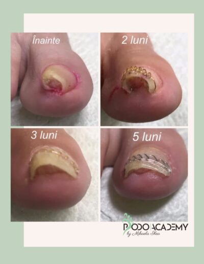 CURS CORECTAREA UNGHIEI INCARNATE CU TEHNICA SHIKAHAMA METHOD – Nivel III